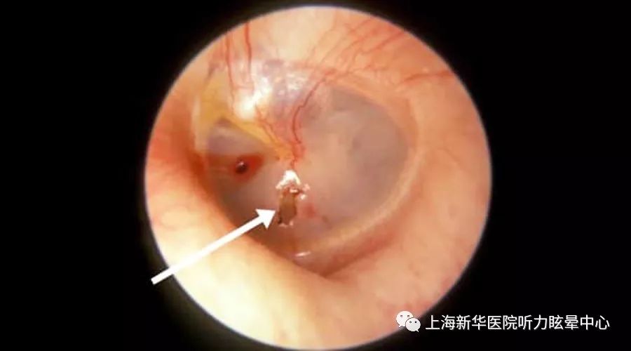 最新发布：耳膜穿孔损害赔偿标准详解及适用指南